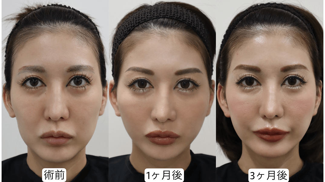 症例1のビフォーアフター
