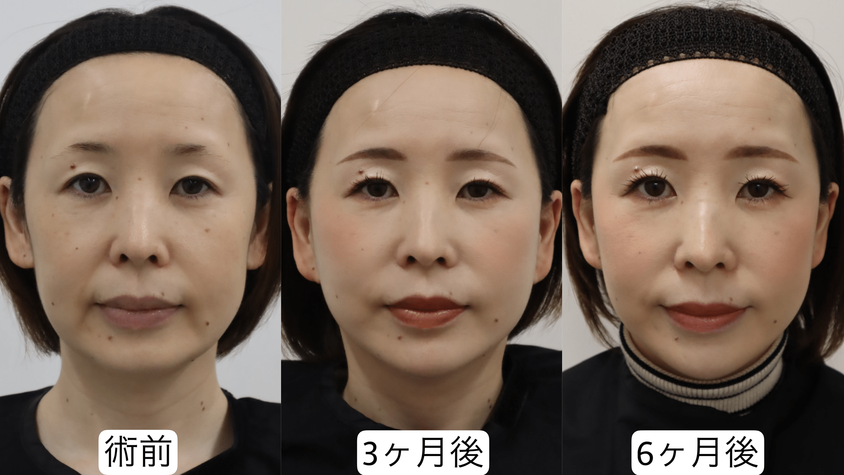 症例3のビフォーアフター