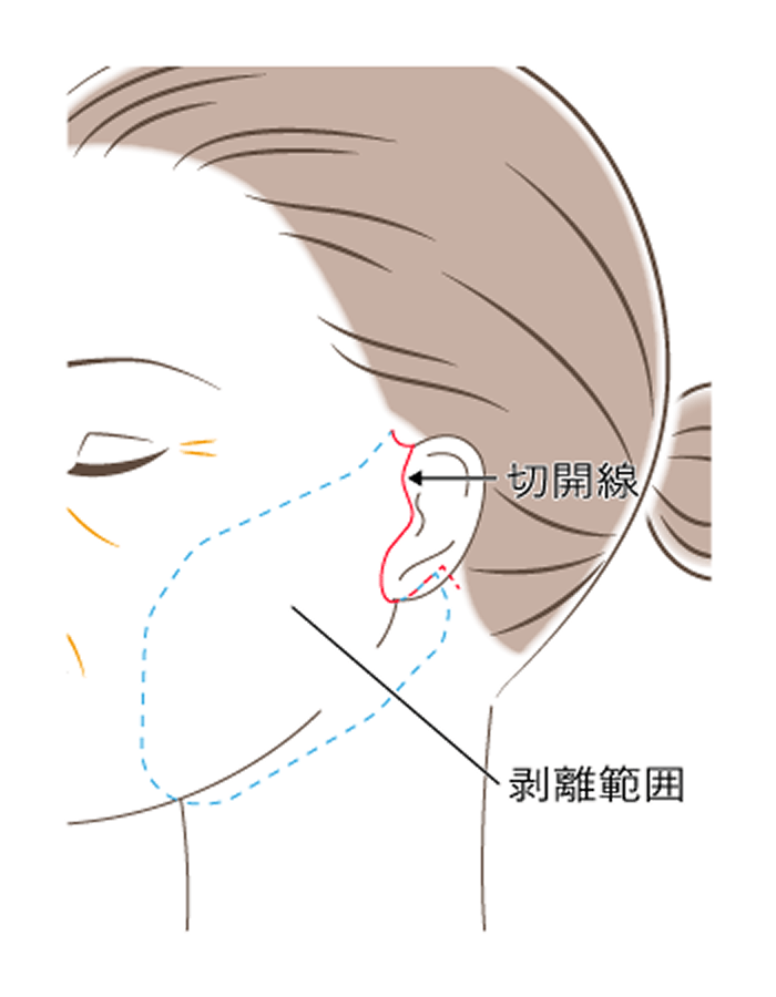 フェイスリフト術式図