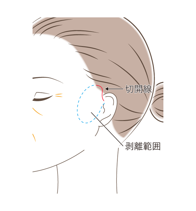 ミニマムリフトの図