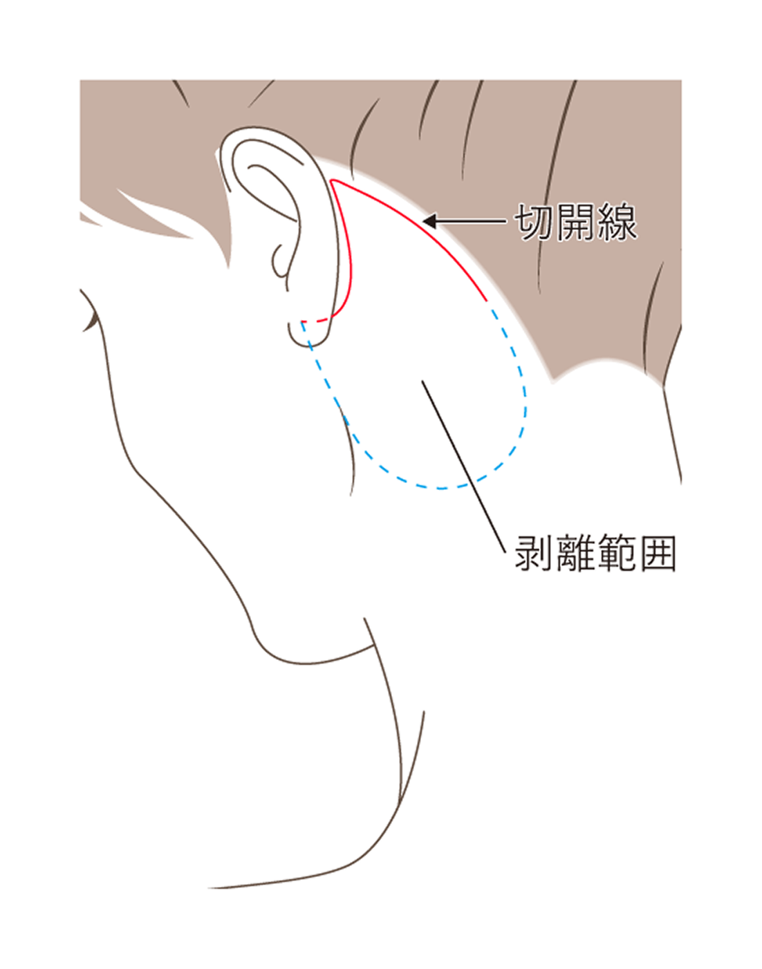 ネックリフトの図
