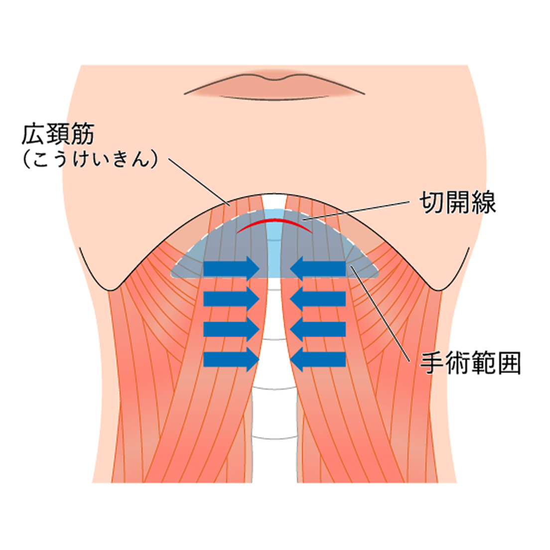 ペリカン手術の図