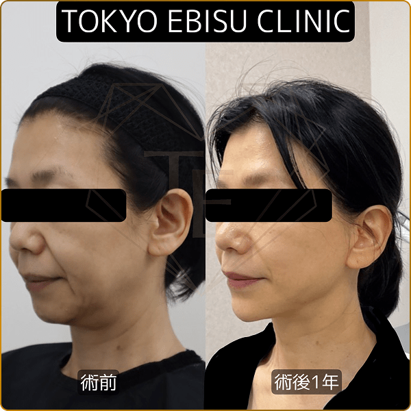 術前と術後1年の比較画像 画面中央上部にTOKYO EBISU CLINIC