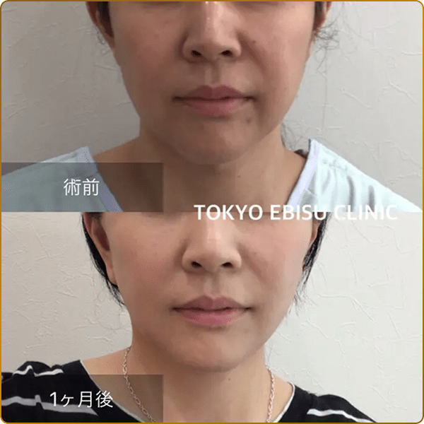 脂肪吸引の術前と1ヶ月後の比較画像