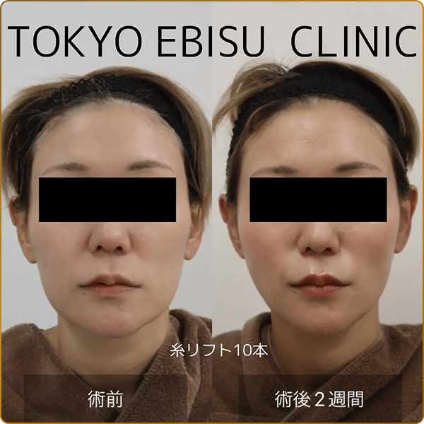 糸リフトの術前と術後2週間の比較画像