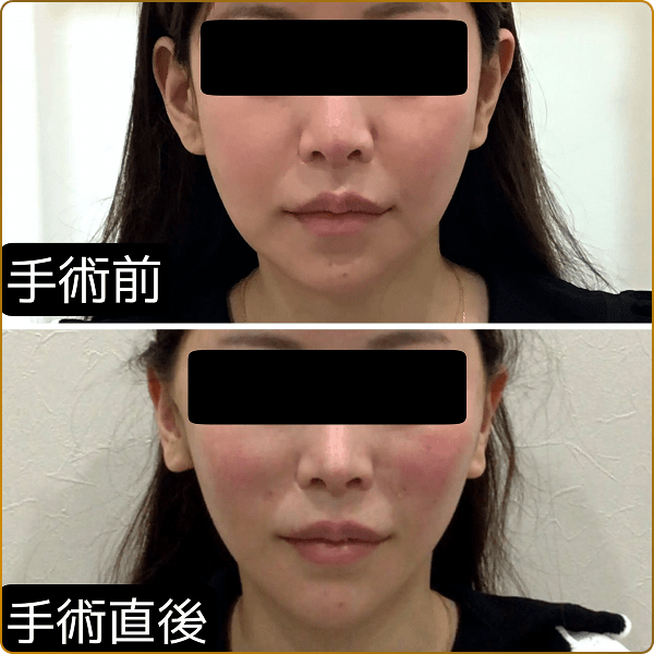 糸リフトの手術前と手術直後の比較画像