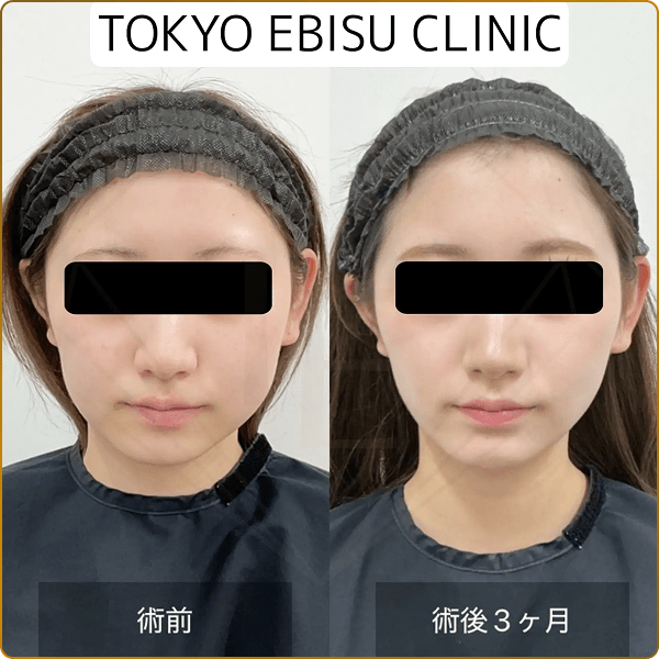 施術組み合わせたものの術前と3ヶ月後の比較画像