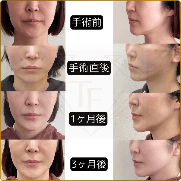 施術組み合わせたものの手術前・手術直後・1ヶ月後・3ヶ月後の比較画像