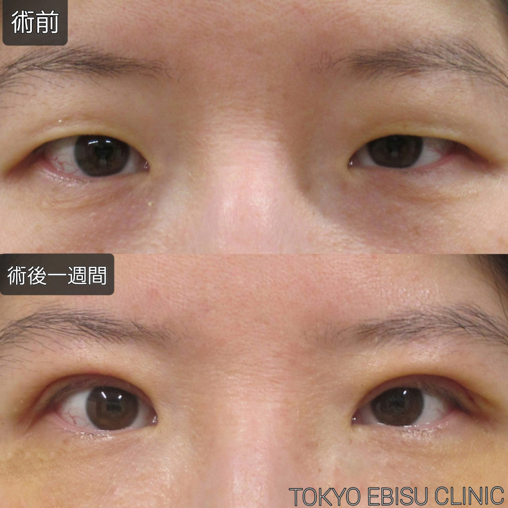 以外に多い 眼瞼下垂 東京エビスクリニック