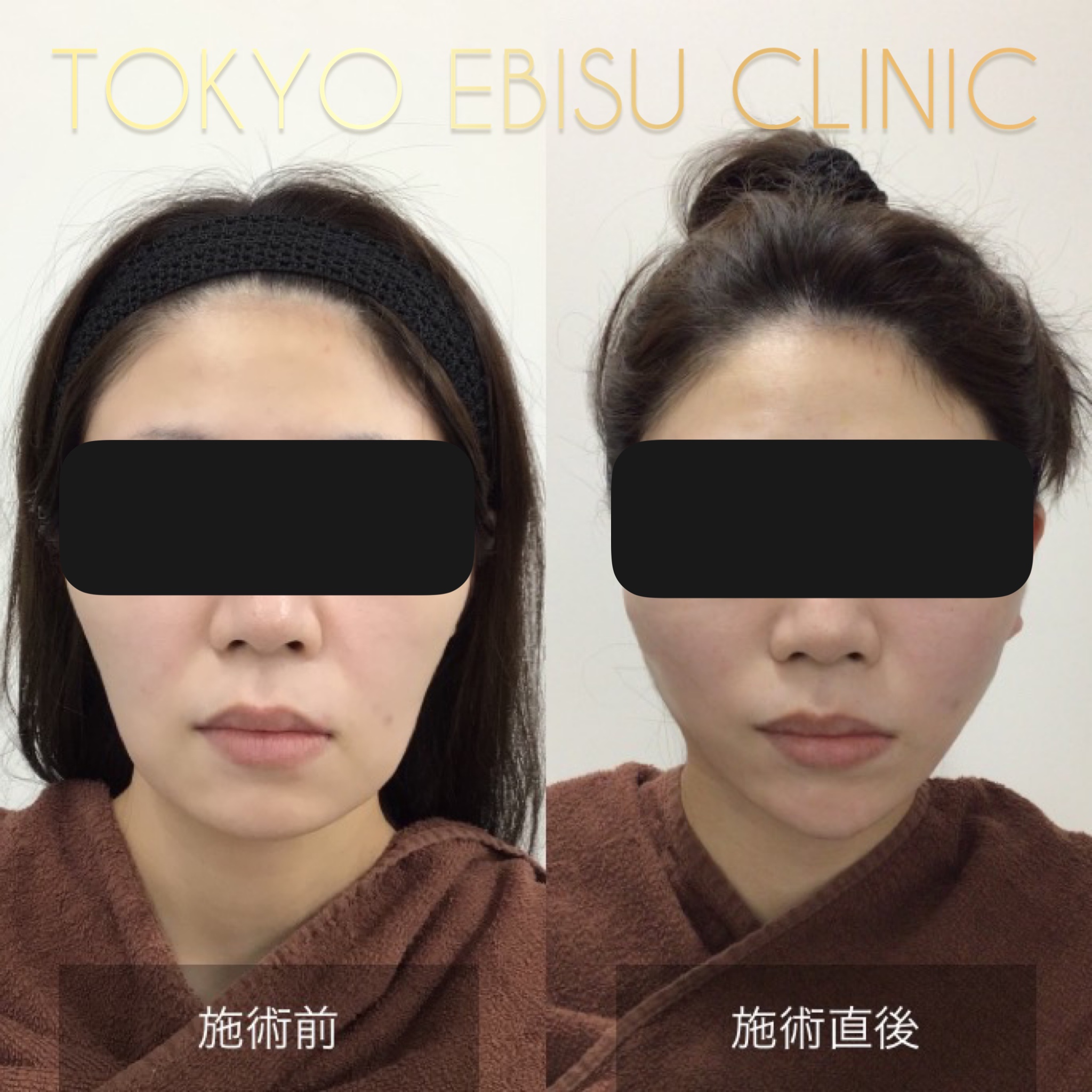 トータルフェイスリフト（Deep planeリガメント法） | 東京エビス