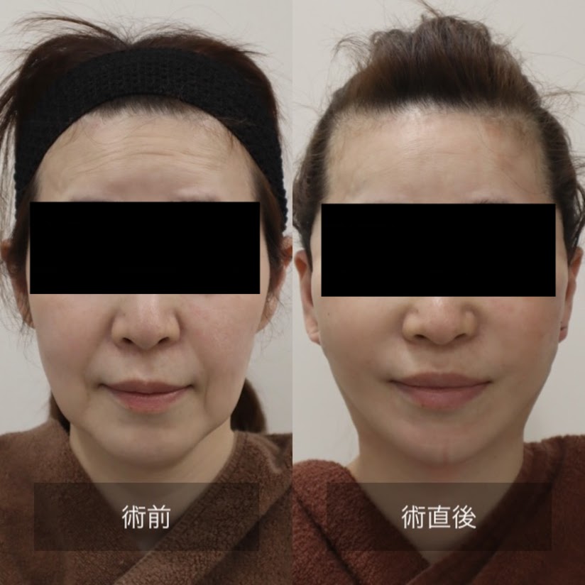 ELAICE フェイスリフト 1825366A-0458-4602-BC82-