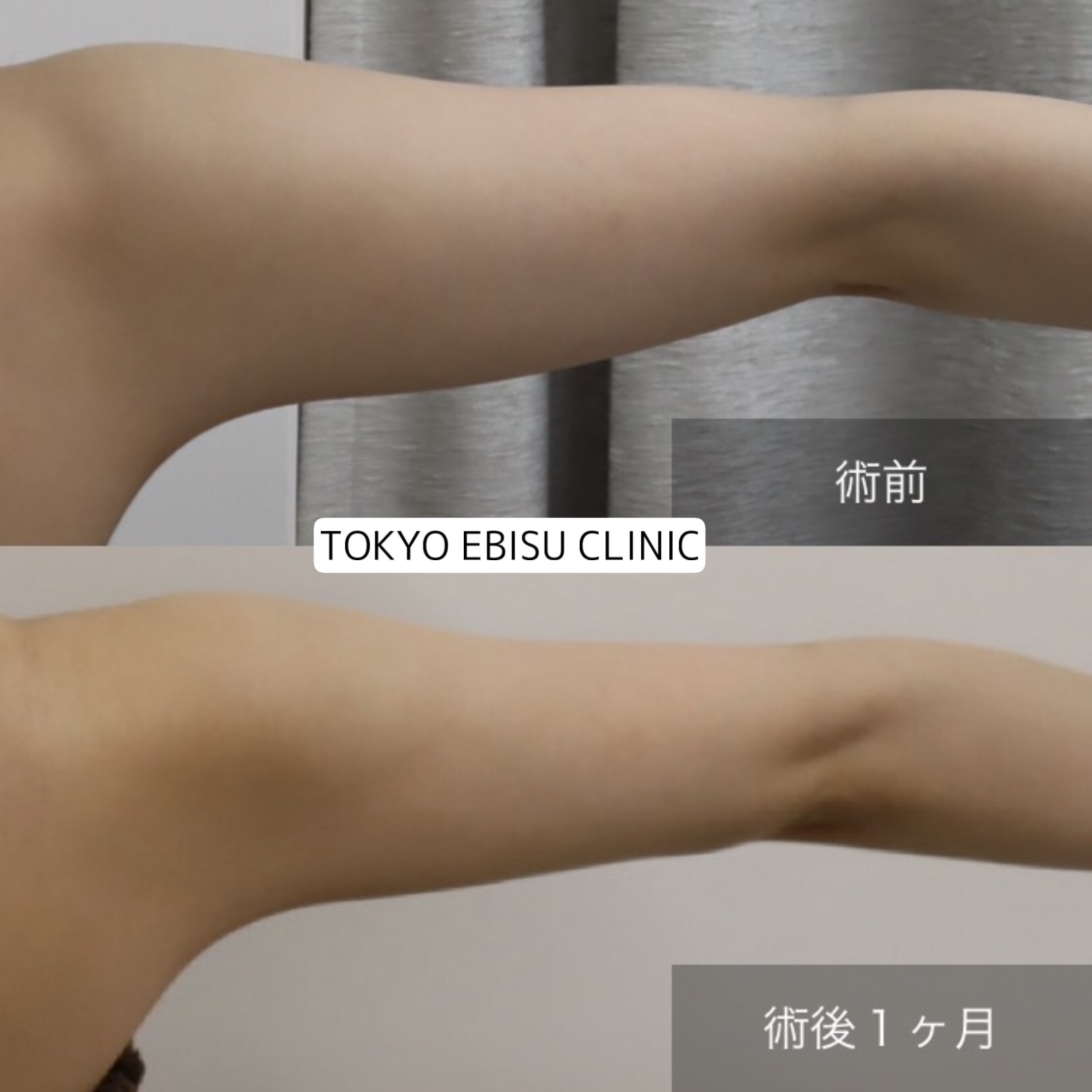 二の腕の脂肪吸引の経過