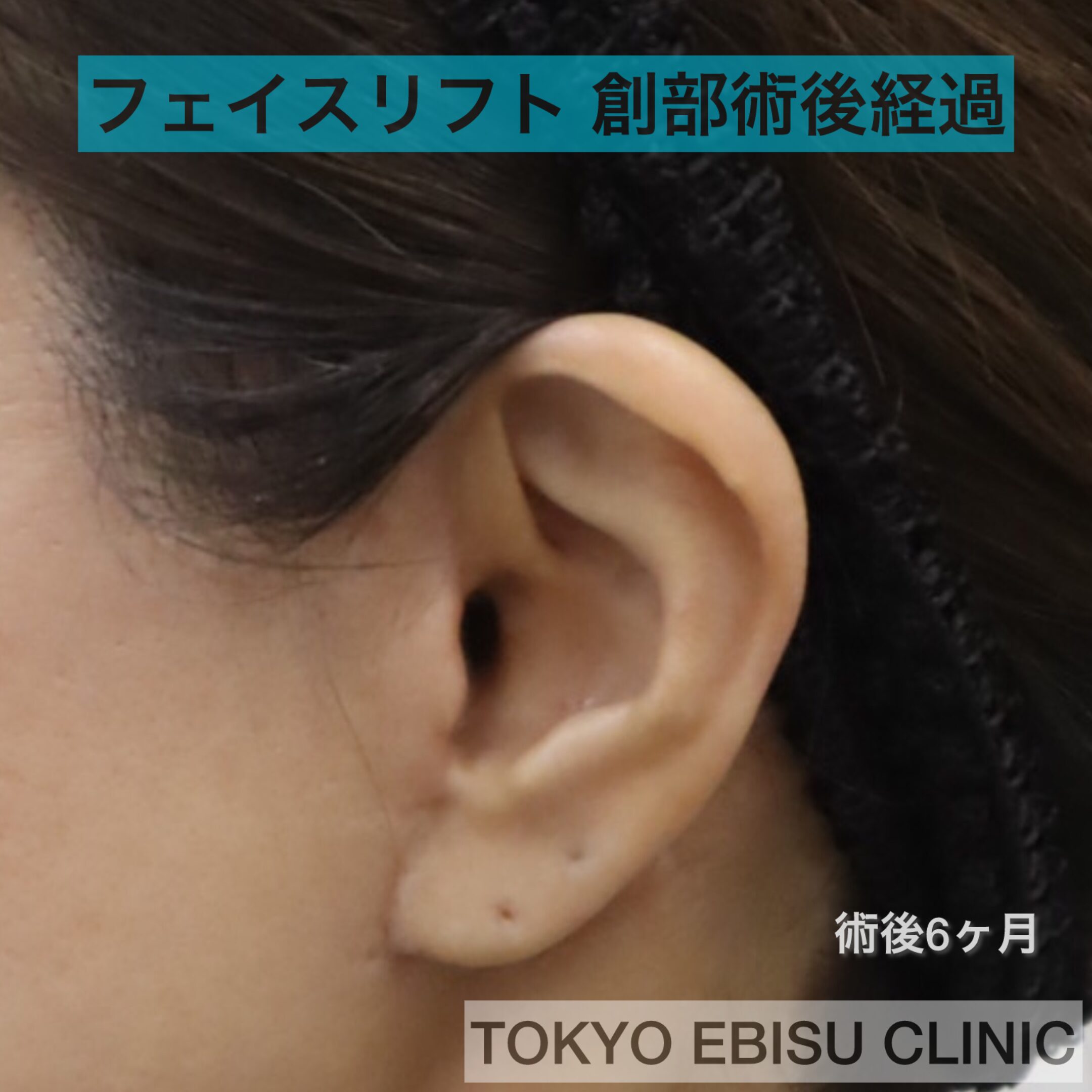 フェイスリフト　傷跡