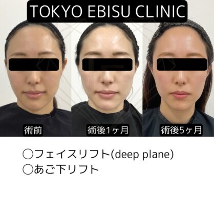 フェイスリフト、あご下リフト　5ヶ月後📷