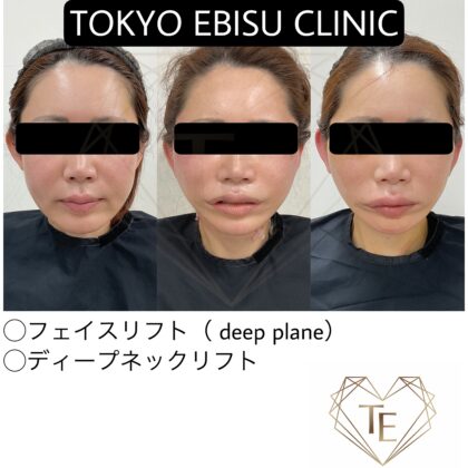 フェイスリフト、ディープネックリフト🪡症例