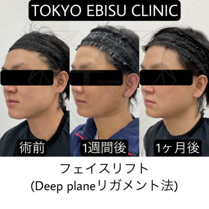 フェイスリフトdeep plane症例💁🏻‍♂️💁‍♂️