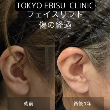フェイスリフトの創部について