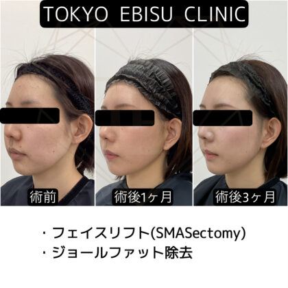 フェイスリフト(SMASectomy法)、ジョールファット除去　3ヶ月後