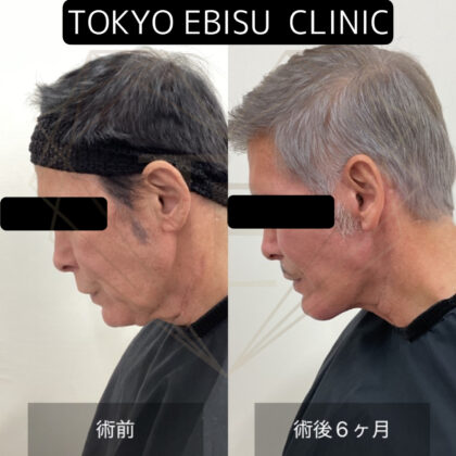 フルフェイスリフト(deepplane,ディープネックリフト,コメカミリフト　術後半年経過症例