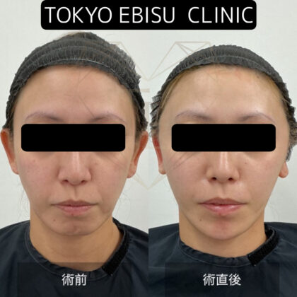 ミニマムリフト症例