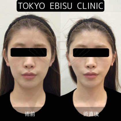 ミニマムリフト 術直後症例