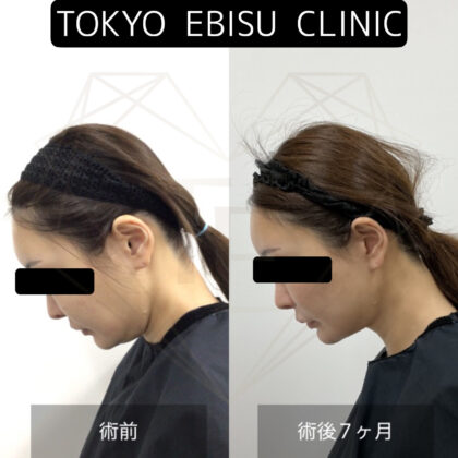 フェイスリフト/ディープネックリフト/ペリカン手術症例