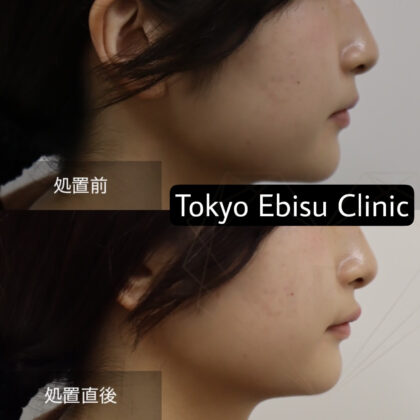 ヒアルロン酸 (リップ)