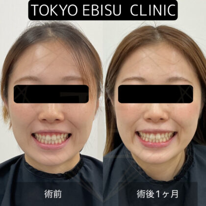 ガミースマイル手術