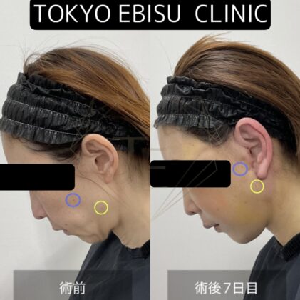 フェイスリフト 40（トータルフェイスリフト） – 40代女性