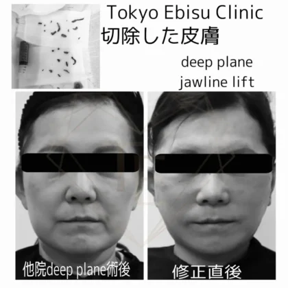 他院修正後のフェイスリフト(Deep plane)/顎下リフト(jawlinelift)/ジョールファット除去