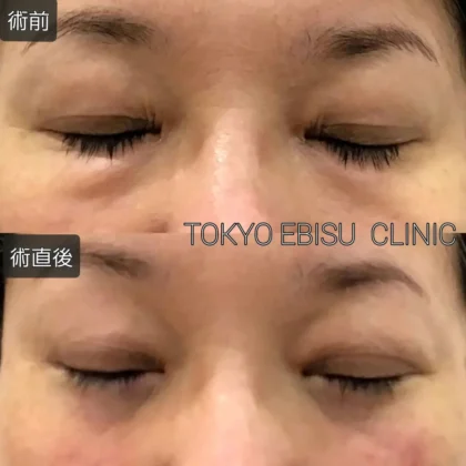 目の下のふくらみ取りSuperior(2部位）