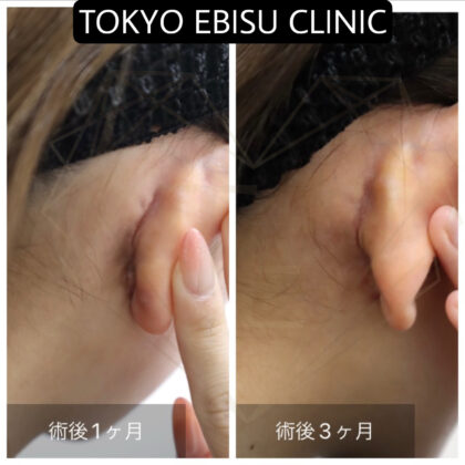 切開リフト創部