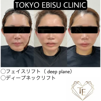 フェイスリフト/ディープネックリフト – 女性