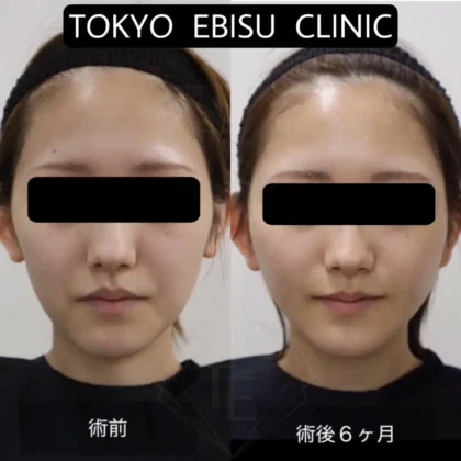 フェイスリフト(deep plane)/あご下リフト/ジョールファット除去（術後6ヶ月）