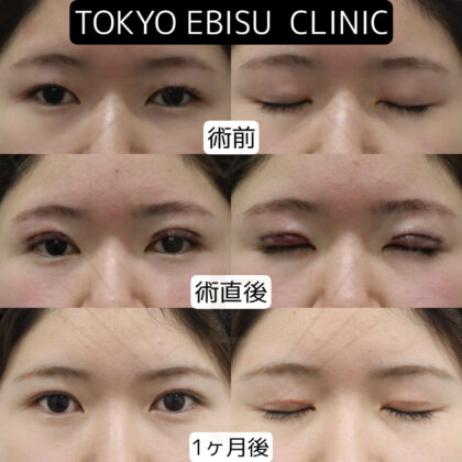 二重切開法/他院埋没抜糸