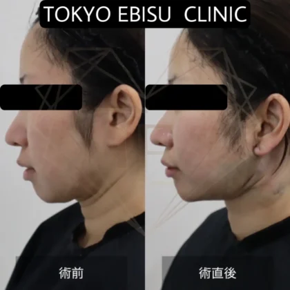 ディープネックリフト – 女性