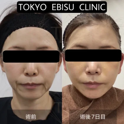 フェイスリフト（ディーププレーン）- 女性