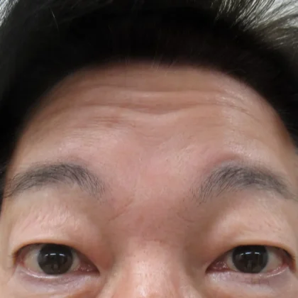 切らない眼瞼下垂術 – 男性