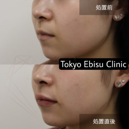 ヒアルロン酸 (リップ上下)