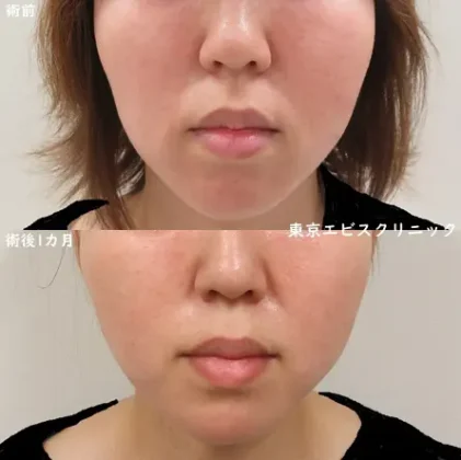 糸リフト（ショッピングスレッドリフトシェイプ） – 女性