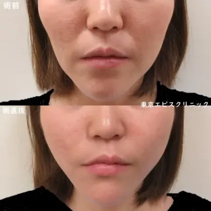 糸リフト（ショッピングスレッドリフトシェイプ）- 30代女性