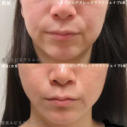 糸リフト（ショッピングスレッドリフトシェイプ）- 20代女性