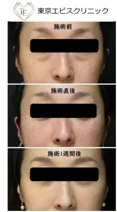 目の下のふくらみ取りSuperior(2部位）- 女性