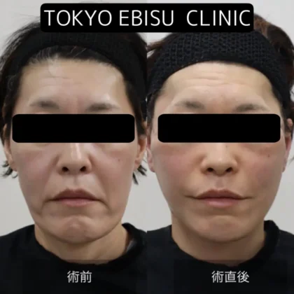 フェイスリフト(Deep plane)/あご下リフト – 女性