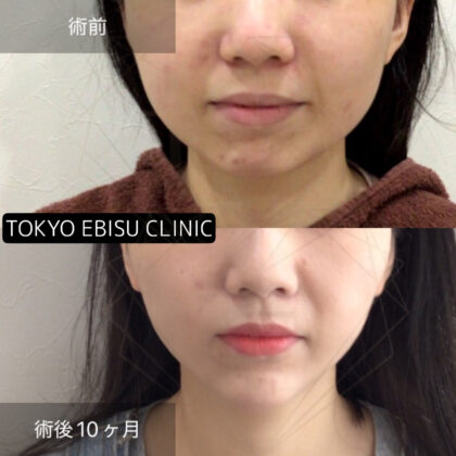 脂肪吸引(頬）、あごヒアルロン酸