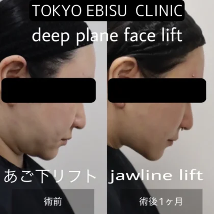 フェイスリフト(Deep plane)/あご下リフト – 女性