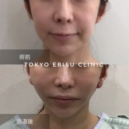 トータルフェイスリフト/あご下切開リフト/頬の脂肪吸引