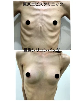 豊胸 シリコンバッグ – 女性