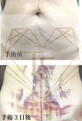 お腹の傷跡修正/たるみ取り
