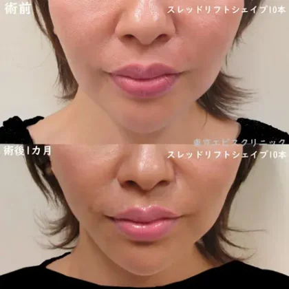 糸リフト（ショッピングスレッドリフトシェイプ10本）- 女性